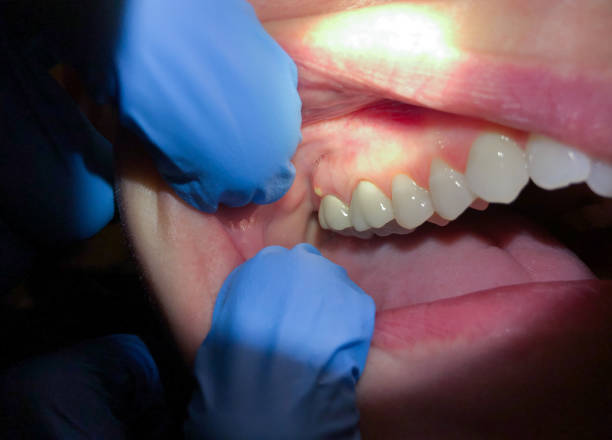 Best Broken or Chipped Tooth Repair in Foscoe, NC
